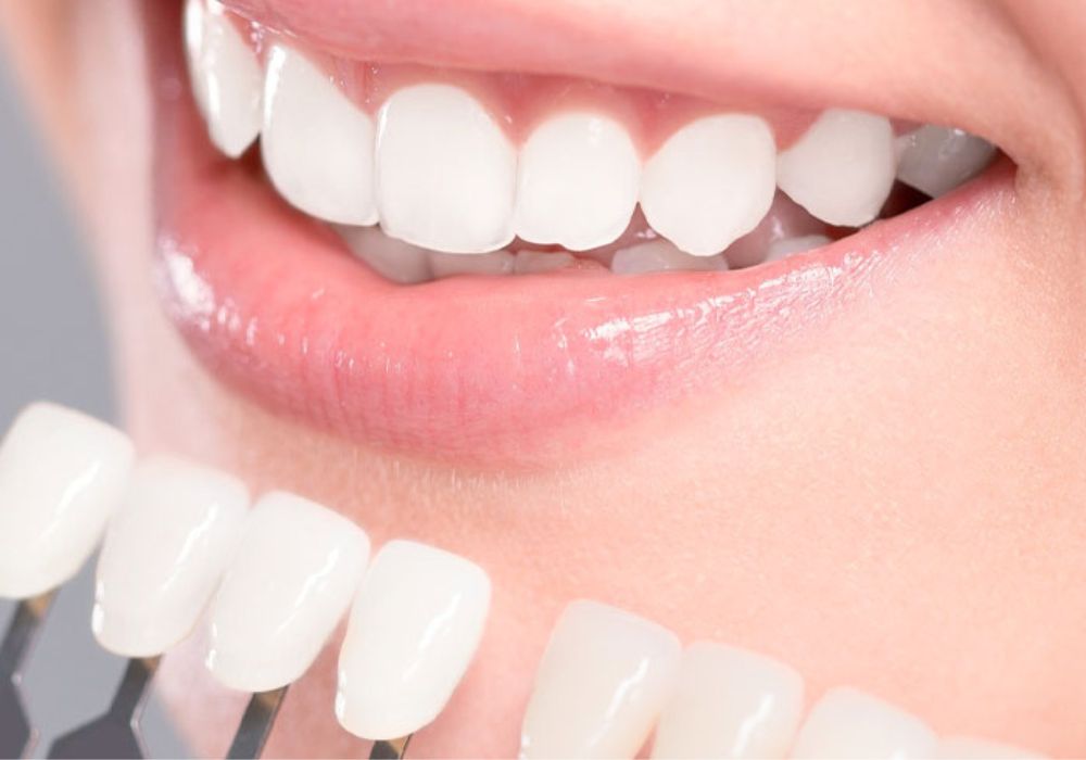 Esthétique Dentaire