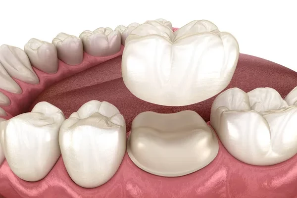 Prothèses Dentaires